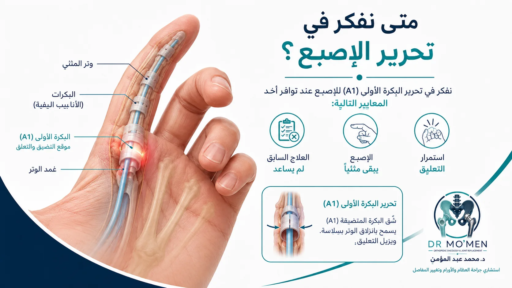 رسم طبي يوضح الحالات التي قد تحتاج إلى عملية تحرير الإصبع الزنادي.
