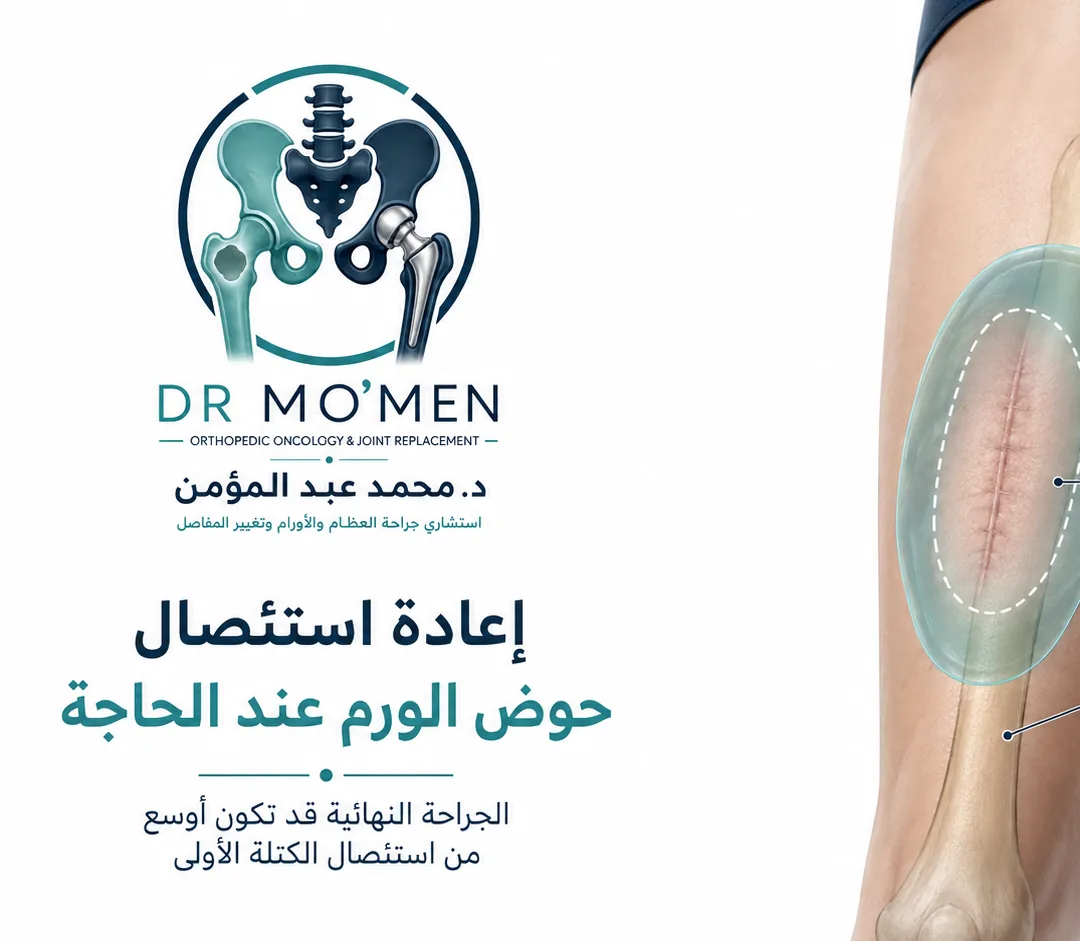 رسم توضيحي لمفهوم إعادة استئصال حوض الساركوما بعد جراحة سابقة غير مخططة