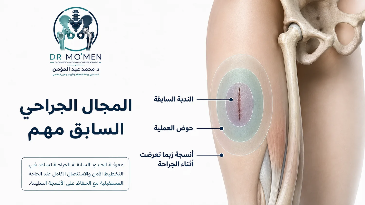 توضيح طبي للندبة وحوض العملية والأنسجة التي ربما تعرضت أثناء الاستئصال غير المخطط للساركوما