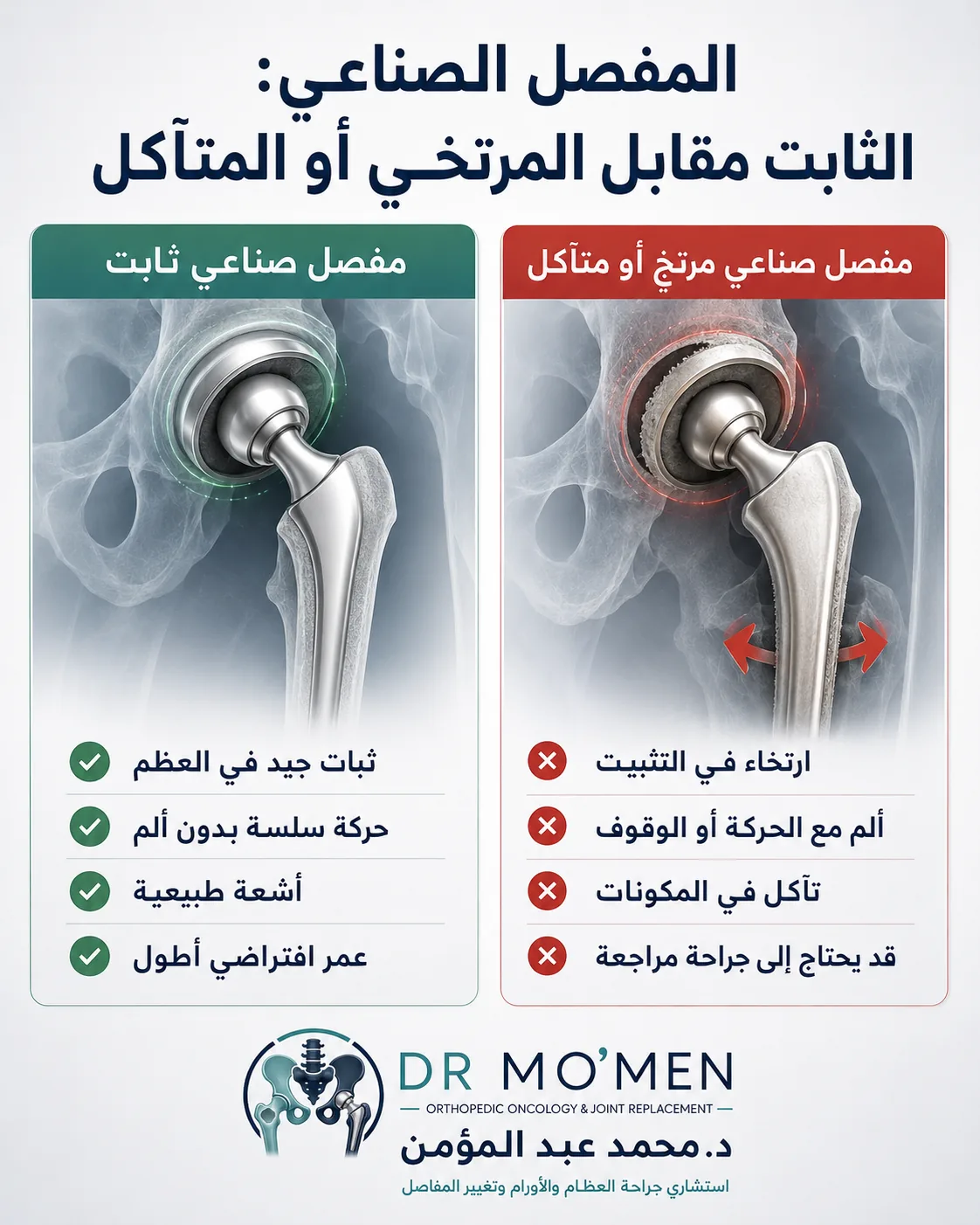الفرق بين المفصل الصناعي الثابت والمفصل الصناعي المرتخي أو المتآكل