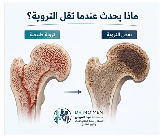 رسم طبي يقارن بين التروية الطبيعية ونقص التروية في رأس عظمة الفخذ.