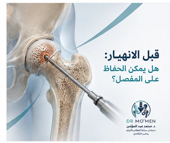 رسم طبي يوضح عملية التثقيب وإزالة الضغط لعلاج AVN قبل الانهيار.