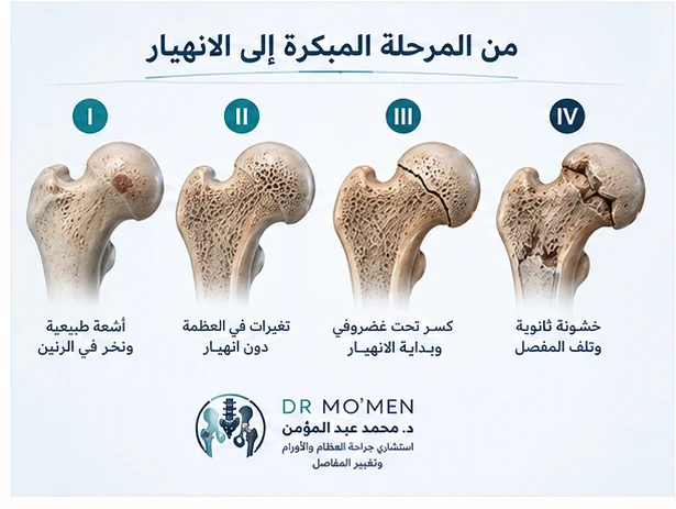 مراحل ARCO من المرض المبكر إلى الانهيار والخشونة الثانوية.