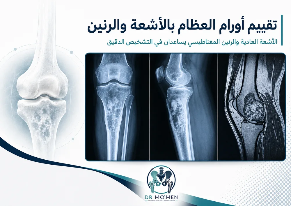 علامات تحذيرية في أورام العظام مثل الألم المستمر والتورم والكسر المرضي علامات تحذيرية في أورام العظام مثل الألم المستمر والتورم والكسر المرضي