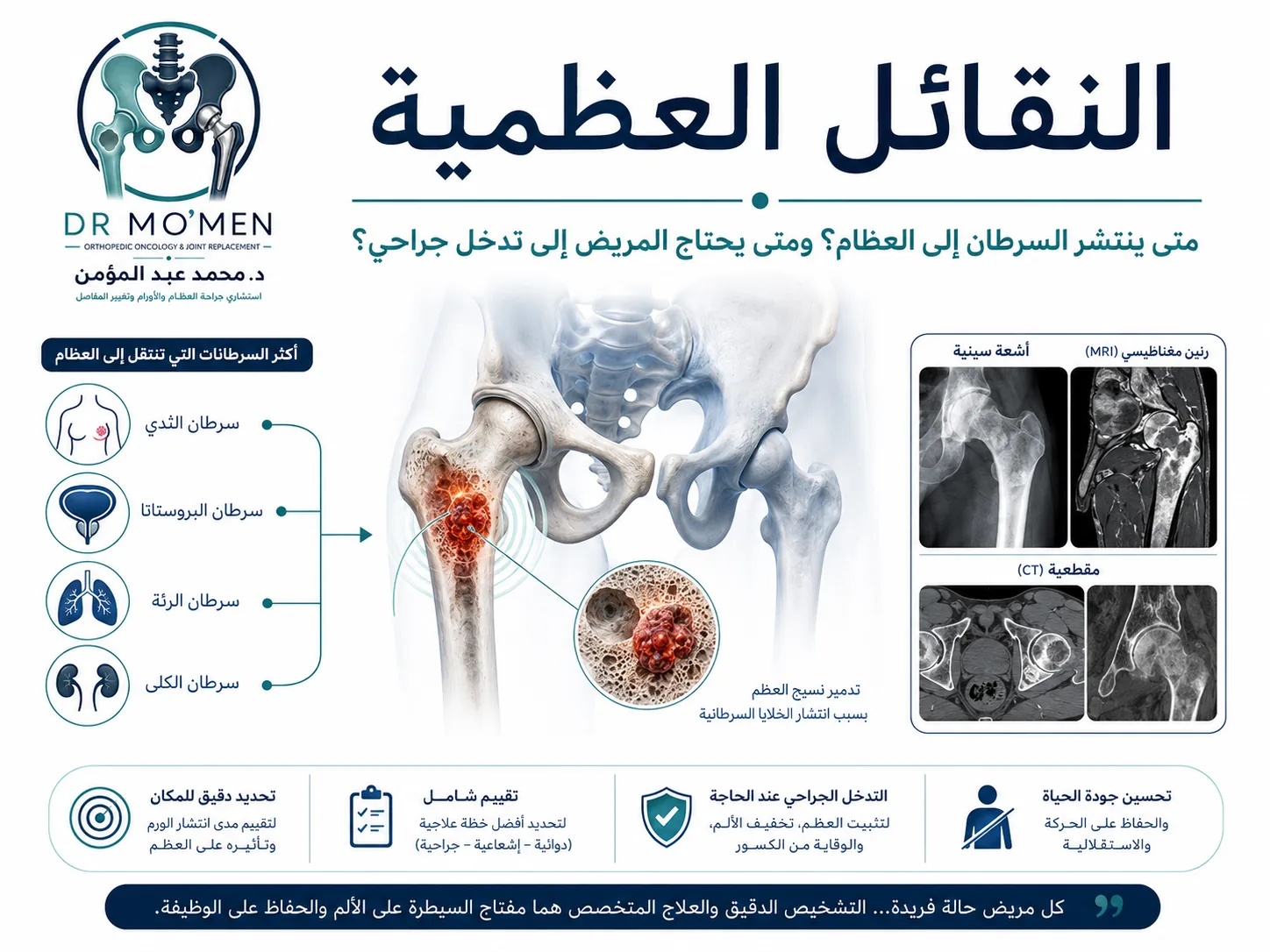 النقائل العظمية وعلاج انتشار السرطان إلى العظام ومتى يحتاج المريض إلى تدخل جراحي