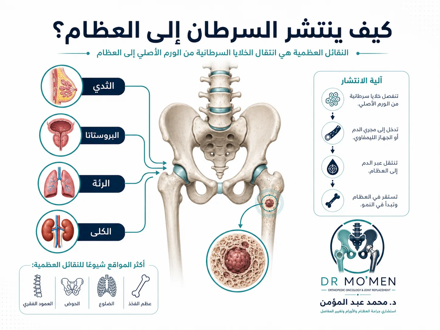 كيف ينتشر السرطان إلى العظام في حالات النقائل العظمية عند مرضى السرطان
