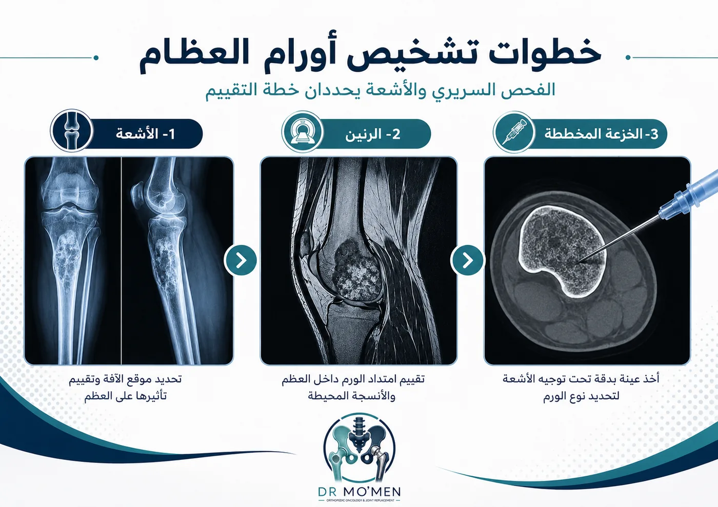 خطوات تشخيص أورام العظام تشمل الأشعة والرنين والخزعة المخططة لتحديد خطة العلاج المناسبة