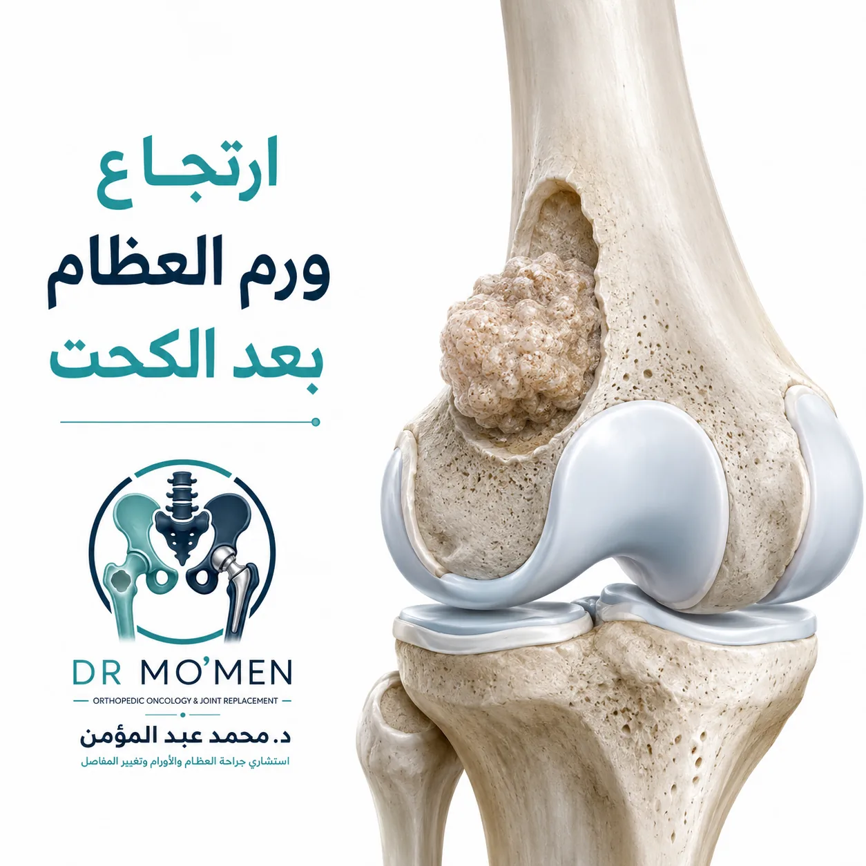 ارتجاع ورم عظمي حول الركبة بعد الكحت مع تقييم إمكانية الحفاظ على المفصل