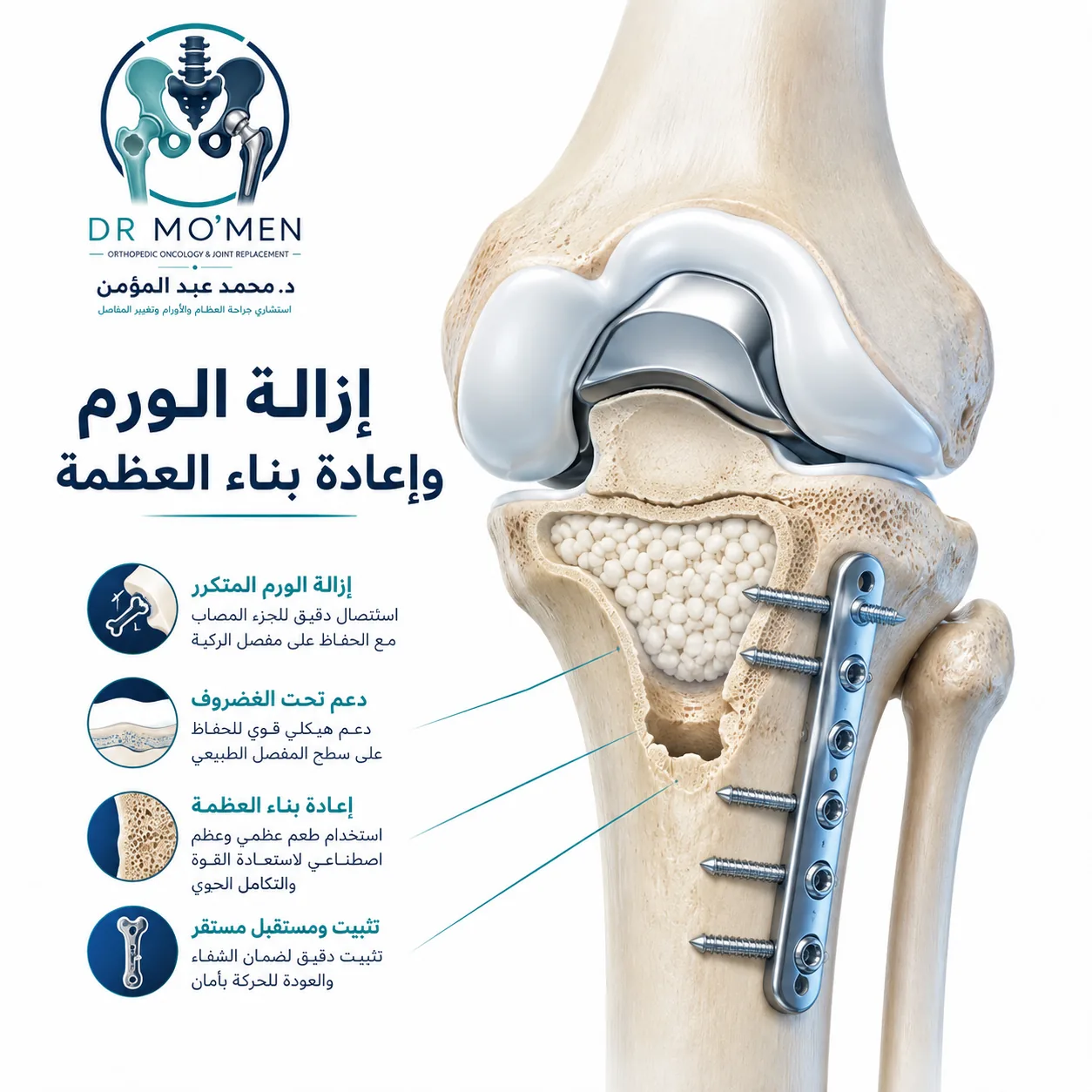 إعادة بناء العظمة بعد إزالة ورم عظمي مرتجع باستخدام دعم تحت الغضروف وطعم عظمي أو أسمنت وتثبيت