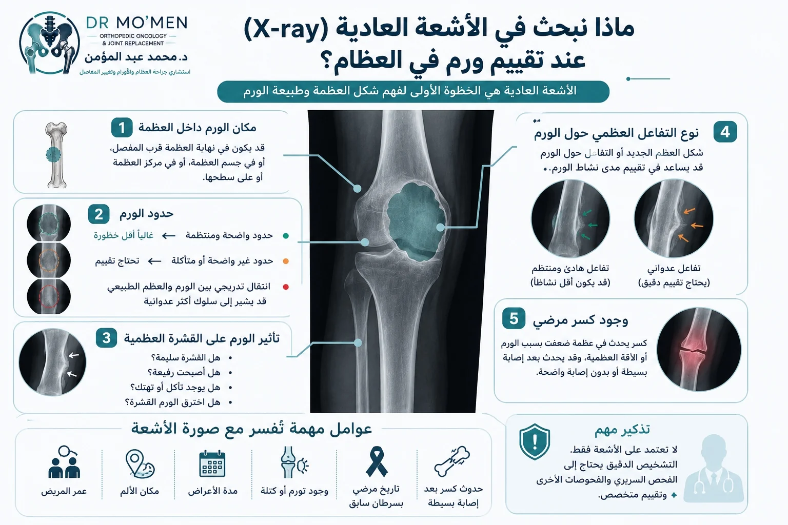 علامات أورام العظام في الأشعة العادية مثل حدود الورم والقشرة العظمية والكسر المرضي