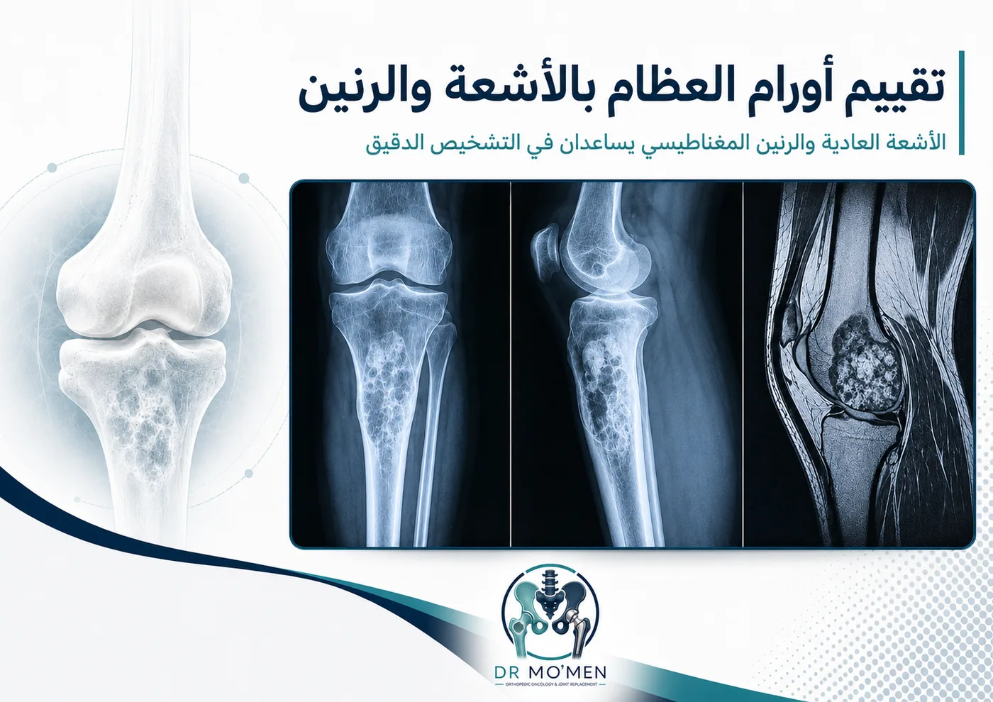 تقييم أورام العظام باستخدام الأشعة العادية والرنين المغناطيسي لتحديد طبيعة الورم وامتداده