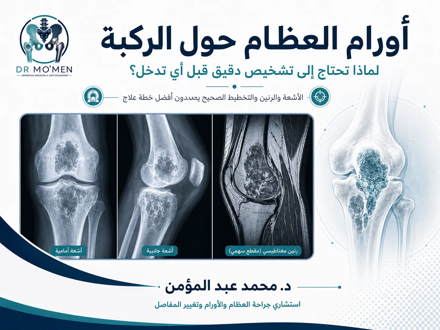 أورام العظام حول الركبة وتشخيص ورم في نهاية عظمة الفخذ أو أعلى عظمة القصبة بالأشعة والرنين