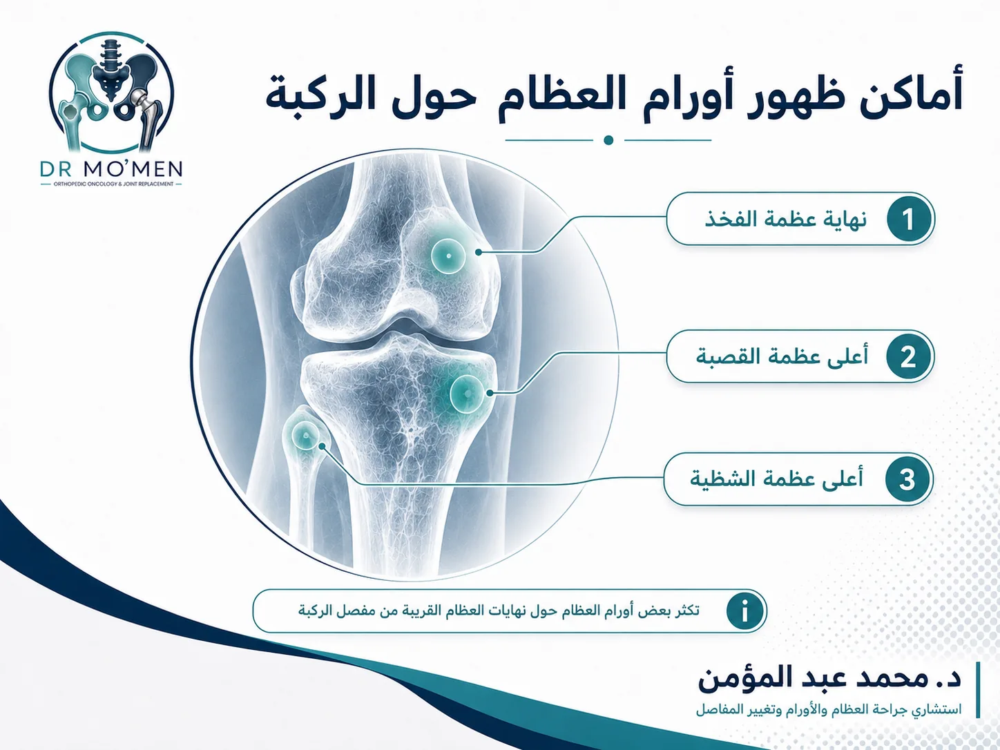أماكن ظهور أورام العظام حول الركبة في نهاية عظمة الفخذ وأعلى عظمة القصبة