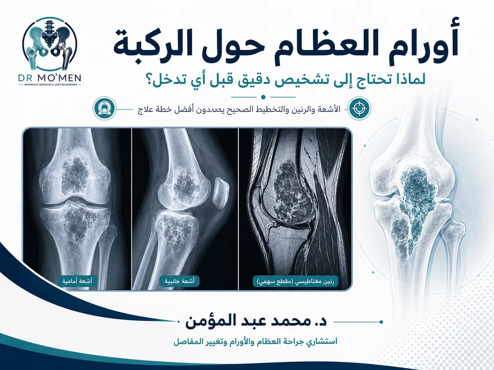 أورام العظام حول الركبة: لماذا تحتاج إلى تشخيص دقيق قبل أي تدخل؟