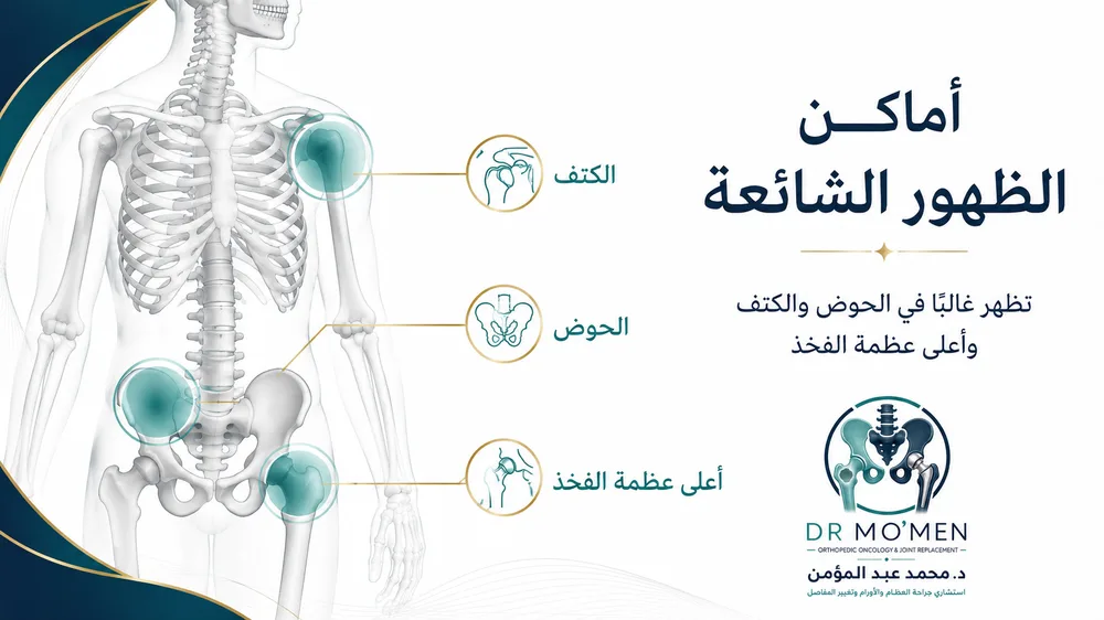 الساركوما الغضروفية Chondrosarcoma — صورة توضيحية داخل المقال رقم 3