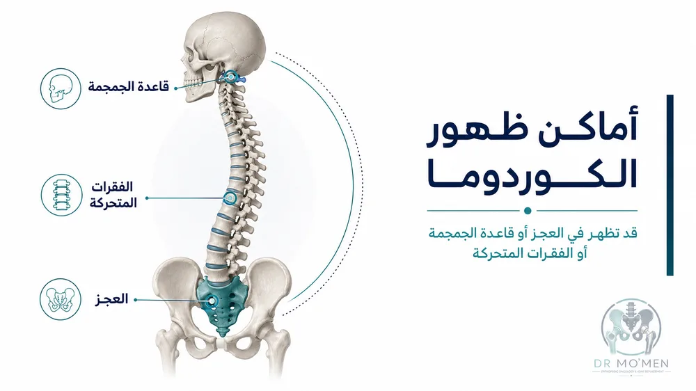 الكوردوما في العجز والعمود الفقري — صورة توضيحية داخل المقال رقم 2