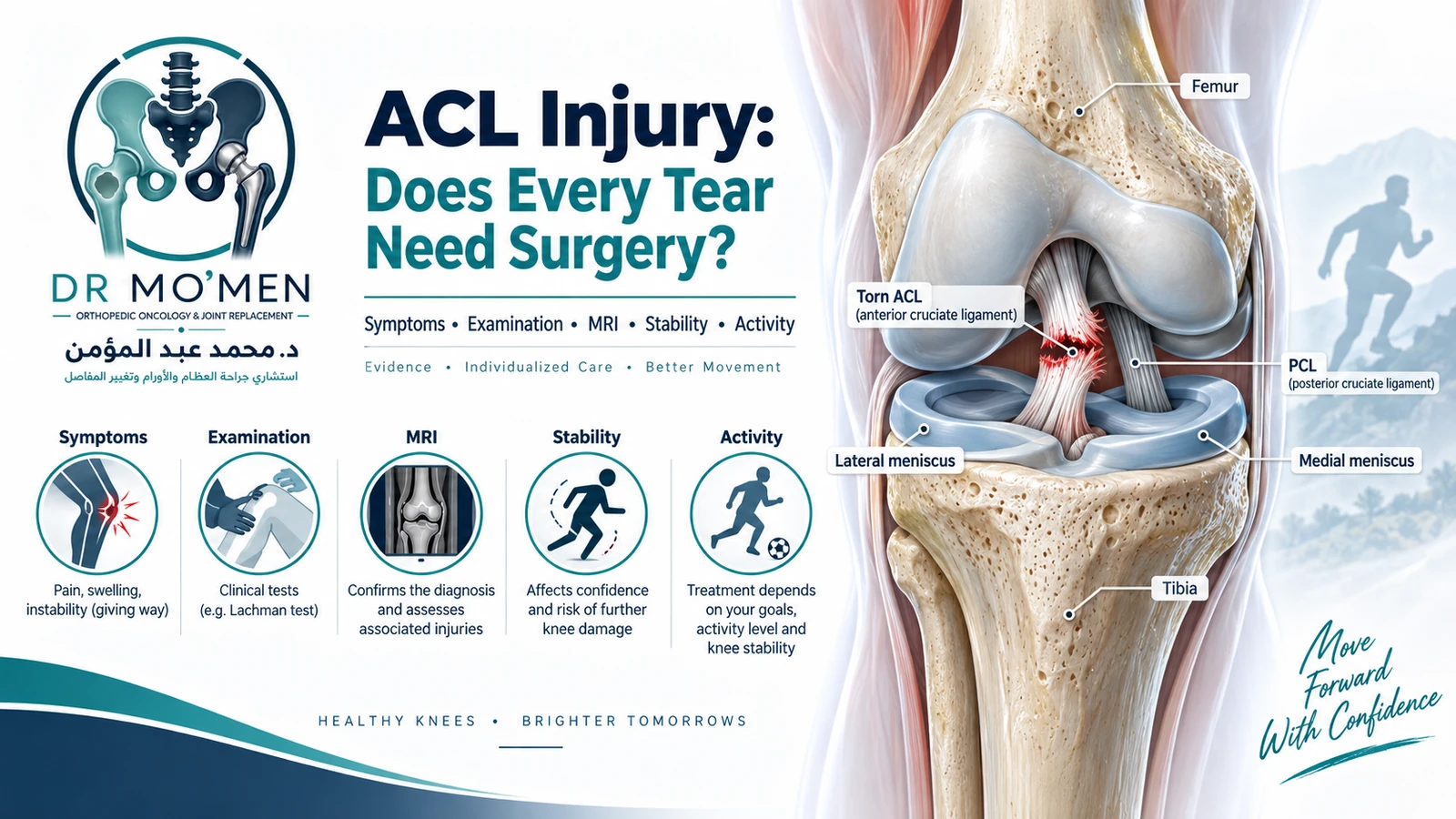 ACL Injury: Does Every Tear Need Surgery? Scientifically accurate illustration of the anterior cruciate ligament showing a torn ACL inside the knee and the main factors that determine treatment.