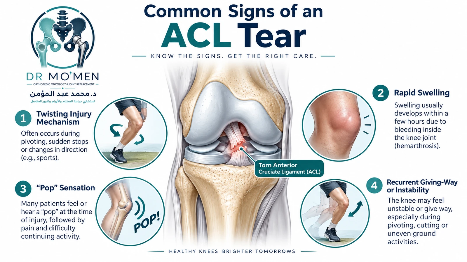 Common Signs of an ACL Tear Medical illustration showing common ACL injury features including twisting injury, rapid swelling, a popping sensation and knee instability.