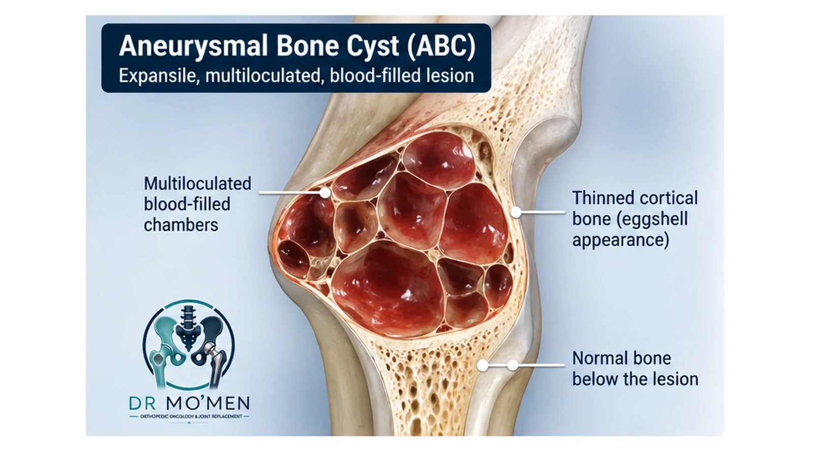 3D medical illustration of an expansile aneurysmal bone cyst with multiloculated blood-filled spaces and a thinned cortical shell.