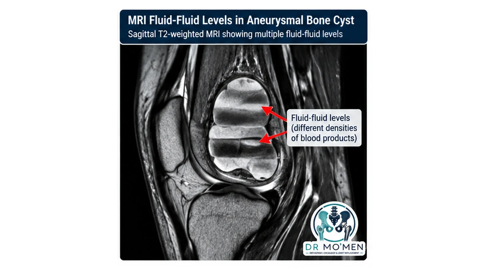 Educational MRI-style illustration showing multiple fluid-fluid levels within a cystic bone lesion; fluid-fluid levels are characteristic but not specific for aneurysmal bone cyst.