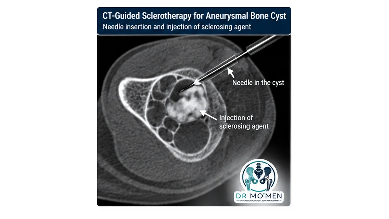 Educational CT-style illustration of image-guided needle placement for percutaneous sclerotherapy of an aneurysmal bone cyst.