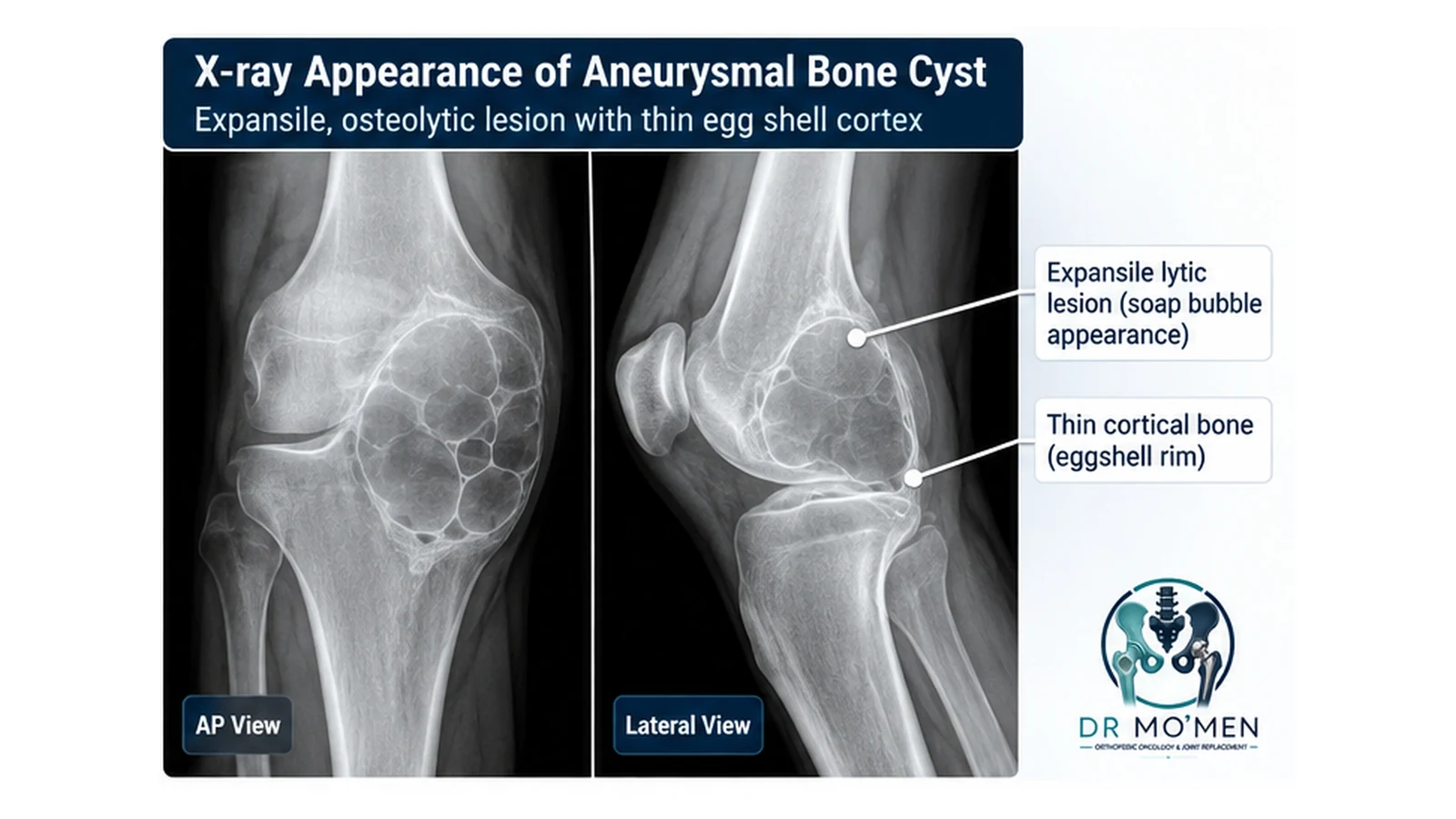 Educational X-ray-style illustration showing an eccentric expansile lytic lesion with cortical thinning consistent with an aneurysmal bone cyst.