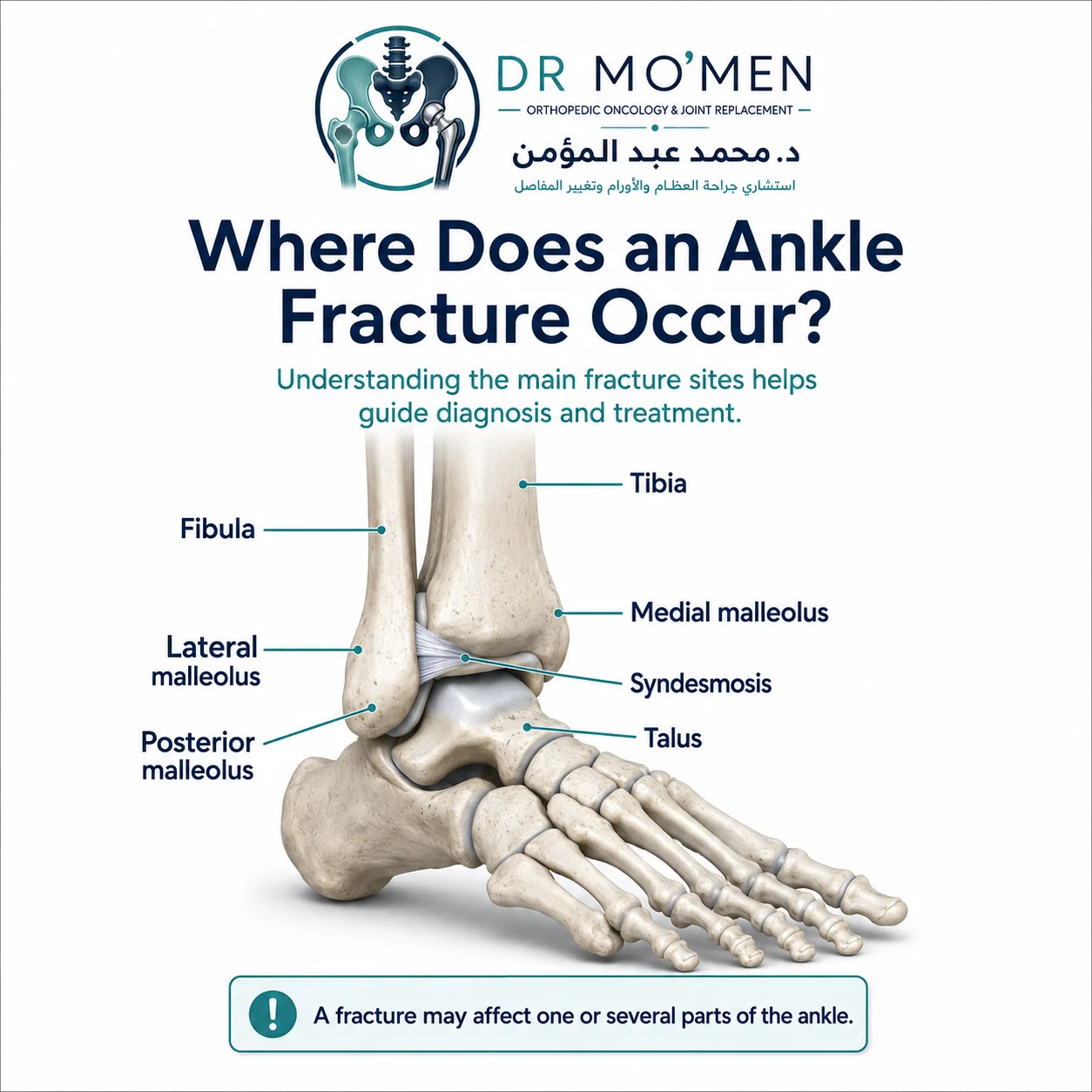 Ankle anatomy infographic showing common fracture sites