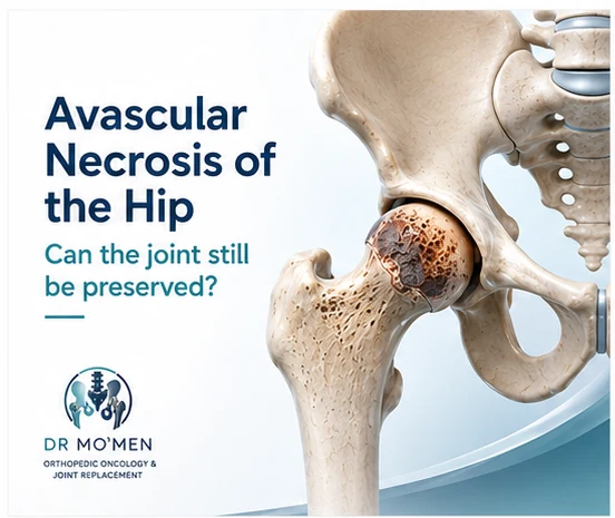 3D medical illustration showing avascular necrosis of the femoral head in the hip