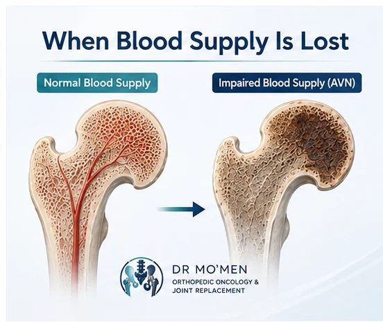 Medical illustration comparing normal femoral head blood supply with impaired blood supply in AVN.