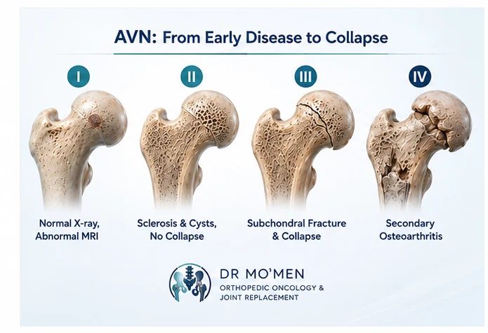 ARCO stages of AVN from early disease to collapse and secondary arthritis.