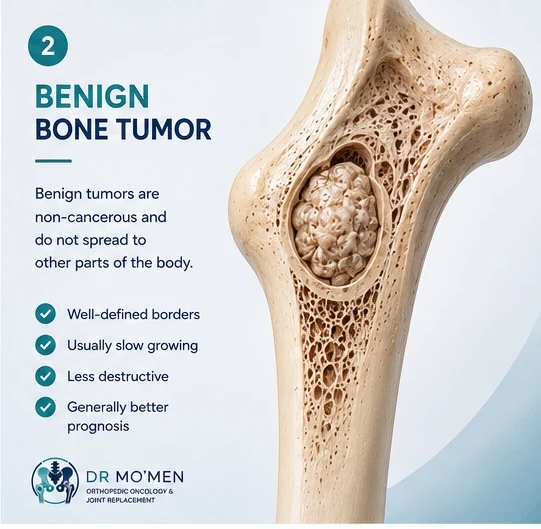 Illustration of a benign bone tumor shown as a well-defined lesion inside bone.