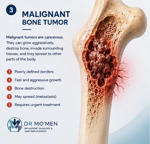 Illustration of a malignant bone tumor with aggressive bone destruction and soft-tissue extension.