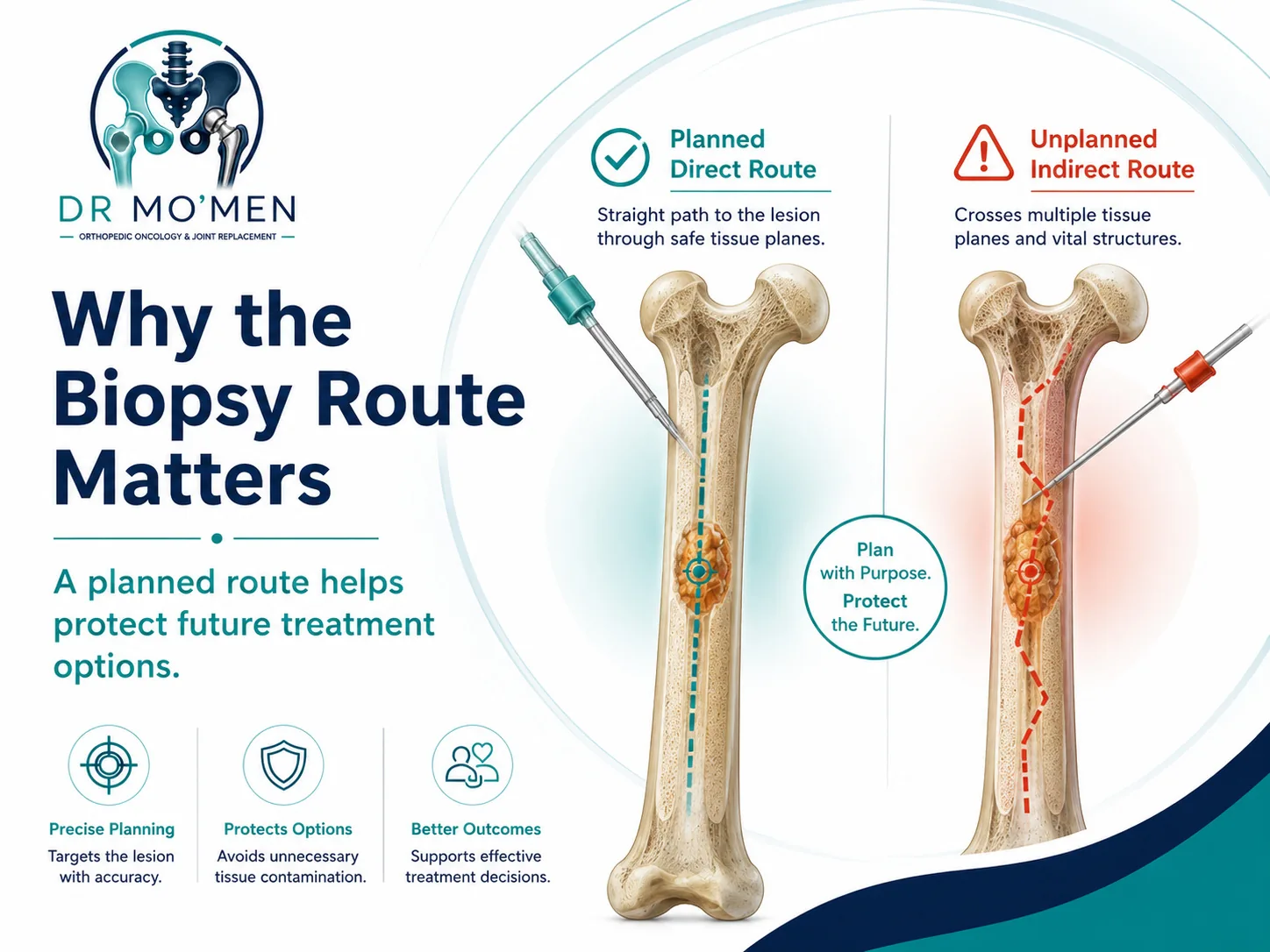 Illustration comparing a planned direct bone biopsy route with an unplanned route crossing unnecessary tissue planes.