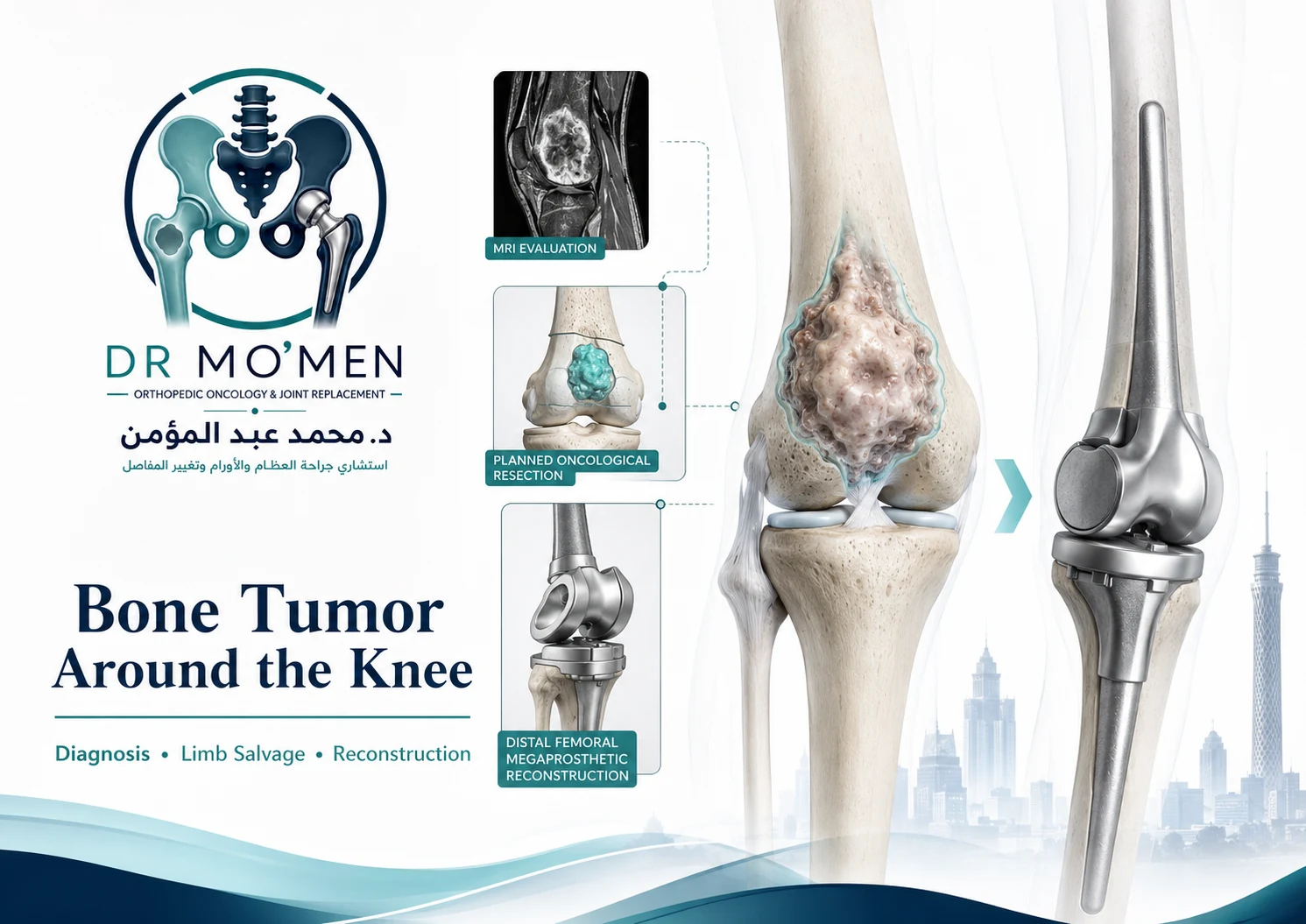 3D orthopedic oncology illustration showing a bone tumor around the knee and limb-salvage reconstruction options