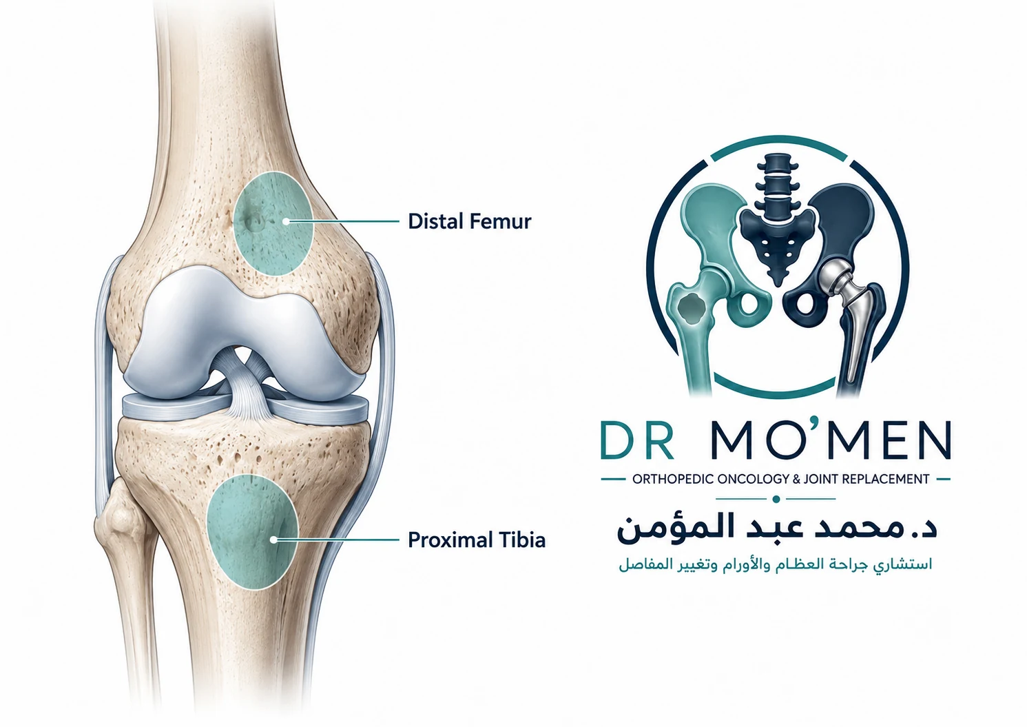 Medical illustration showing distal femoral and proximal tibial locations of bone tumors around the knee