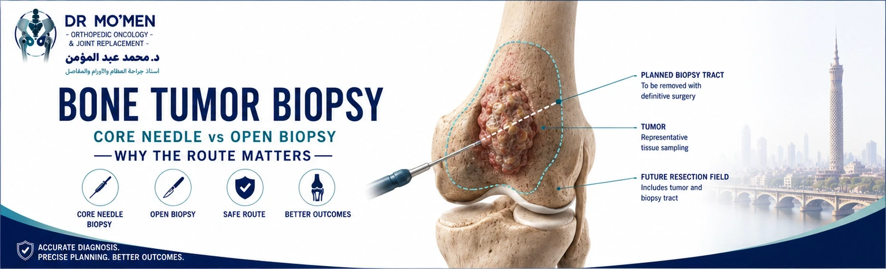 Orthopedic oncology illustration showing planned core needle and open biopsy concepts for a suspicious bone tumor.