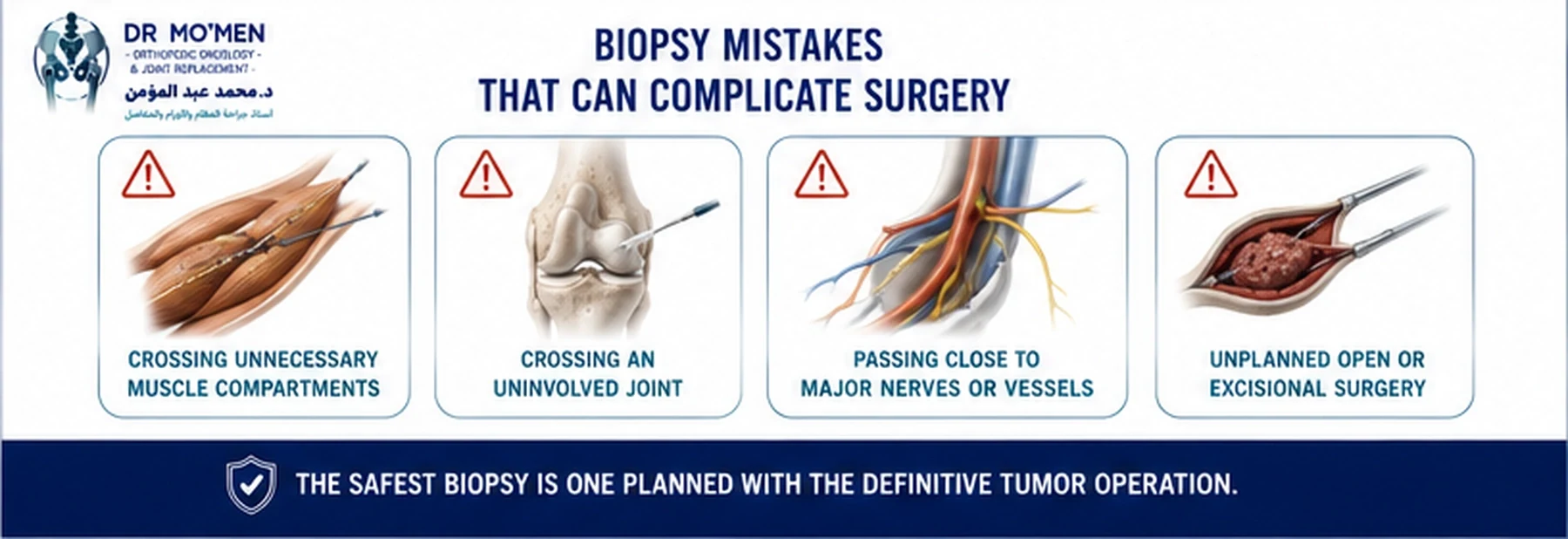 Orthopedic oncology infographic showing common biopsy planning errors that may complicate definitive bone tumor surgery.