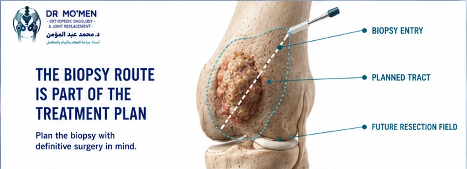 Medical illustration showing a correctly planned biopsy tract that can be removed during definitive bone tumor surgery.