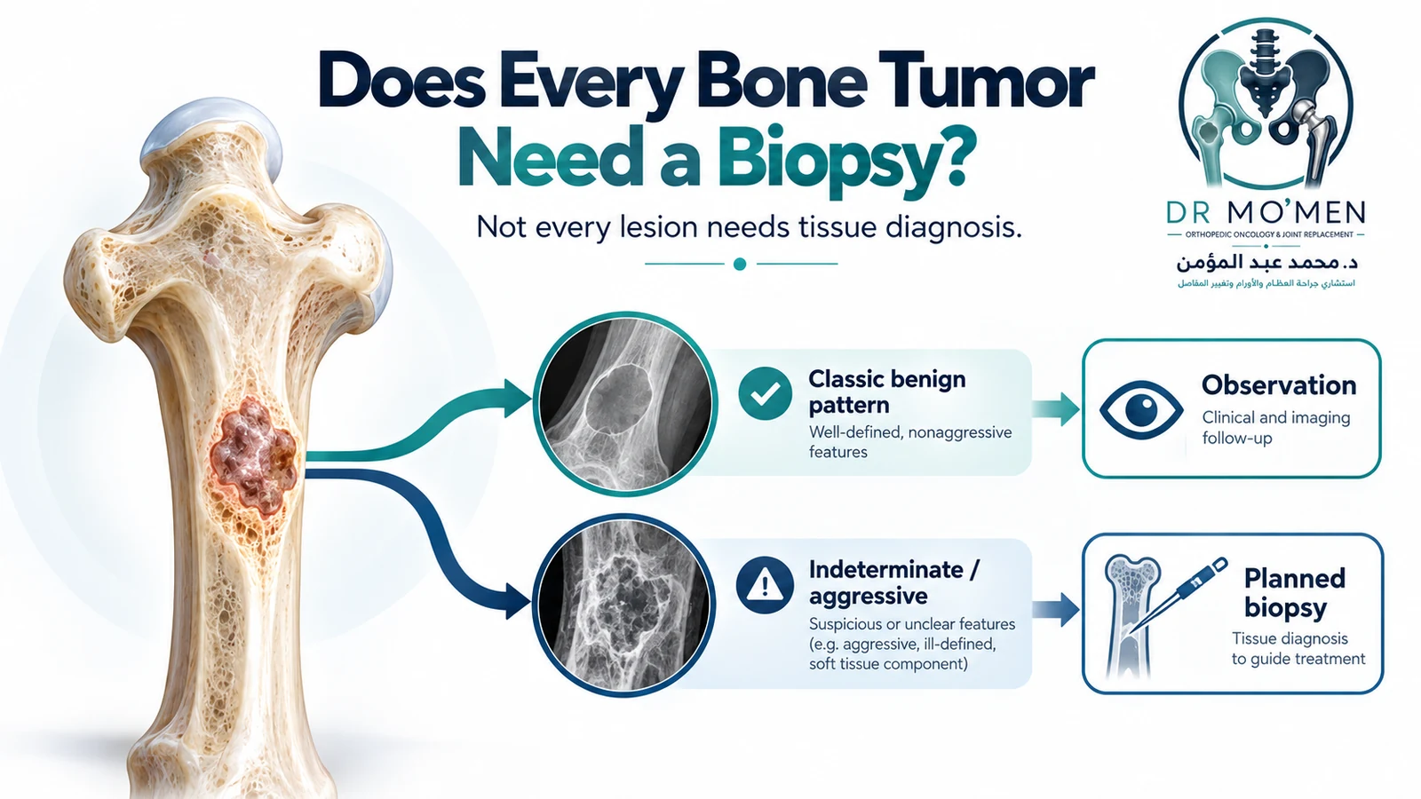 Does Every Bone Tumor Need a Biopsy? Branded orthopedic oncology infographic showing observation for a classic benign bone lesion and planned biopsy for an indeterminate or aggressive lesion.