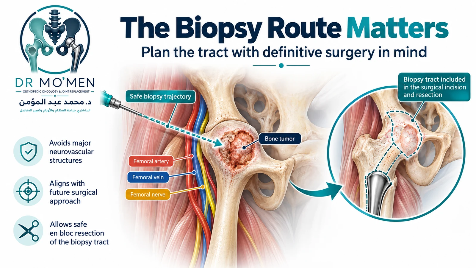 The Biopsy Route Matters Conceptual orthopedic oncology illustration showing a planned bone tumor biopsy trajectory that avoids major neurovascular structures and can be incorporated into later definitive surgery.