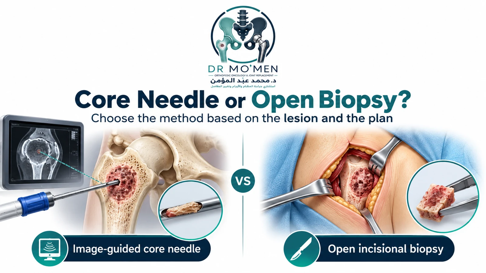 Core Needle or Open Biopsy? Medical illustration comparing image-guided core needle biopsy with open incisional biopsy for a bone tumor.