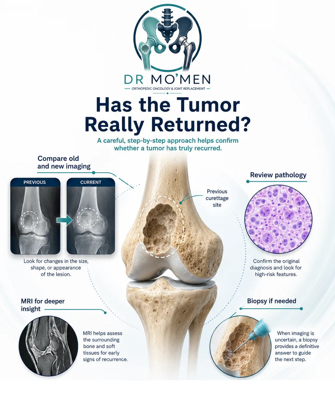 Evaluation of suspected recurrent bone tumor using previous imaging MRI pathology review and biopsy when needed