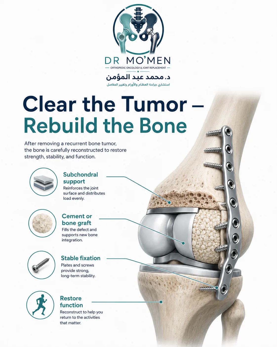 Bone reconstruction after recurrent tumor curettage using subchondral support graft or cement and fixation