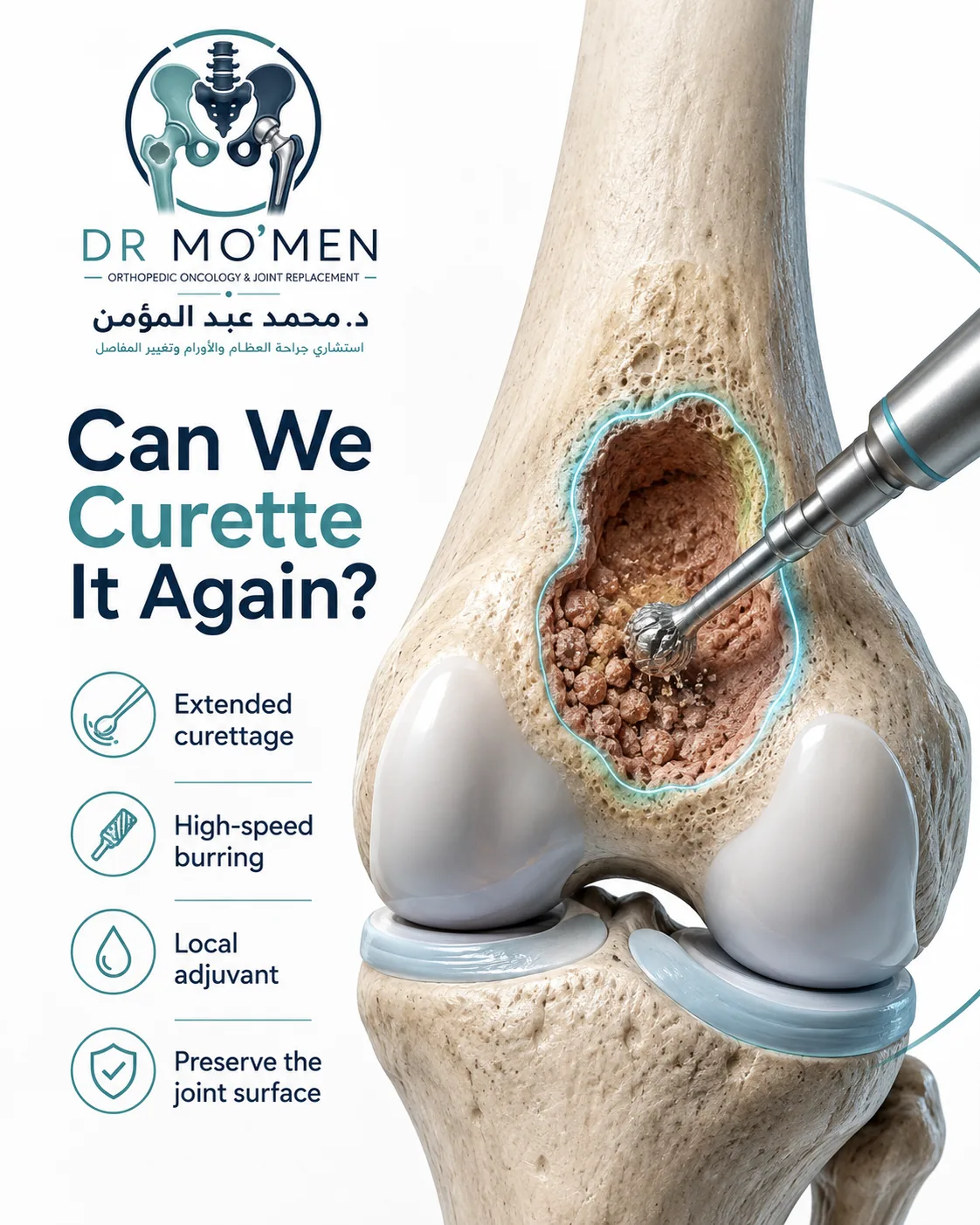 Repeat extended curettage of a recurrent bone tumor with high-speed burring while preserving the joint surface