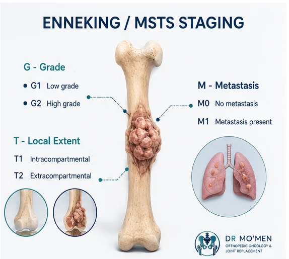 Medical illustration explaining Enneking MSTS bone tumor staging by grade local extent and metastasis