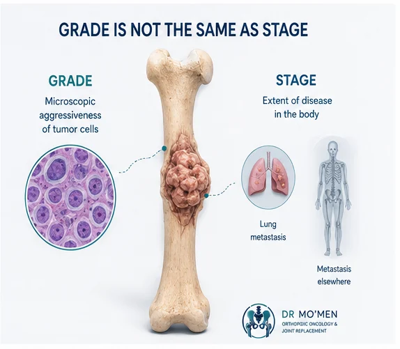 Bone tumor grade versus stage patient education illustration explaining the difference