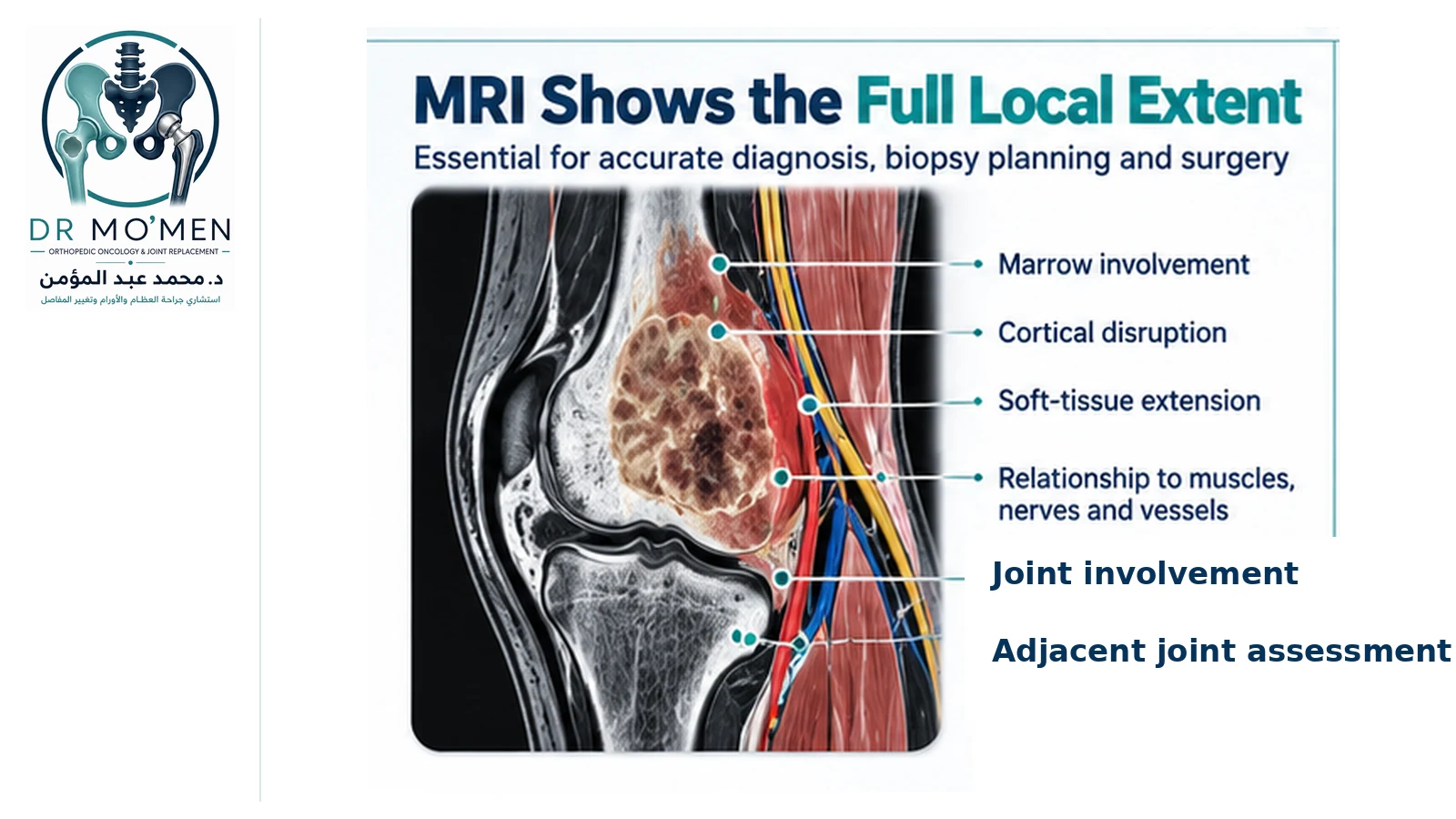 MRI Shows the Full Local Extent Orthopedic oncology infographic showing how MRI demonstrates marrow involvement, cortical disruption, soft-tissue extension, neurovascular relationships and joint involvement.