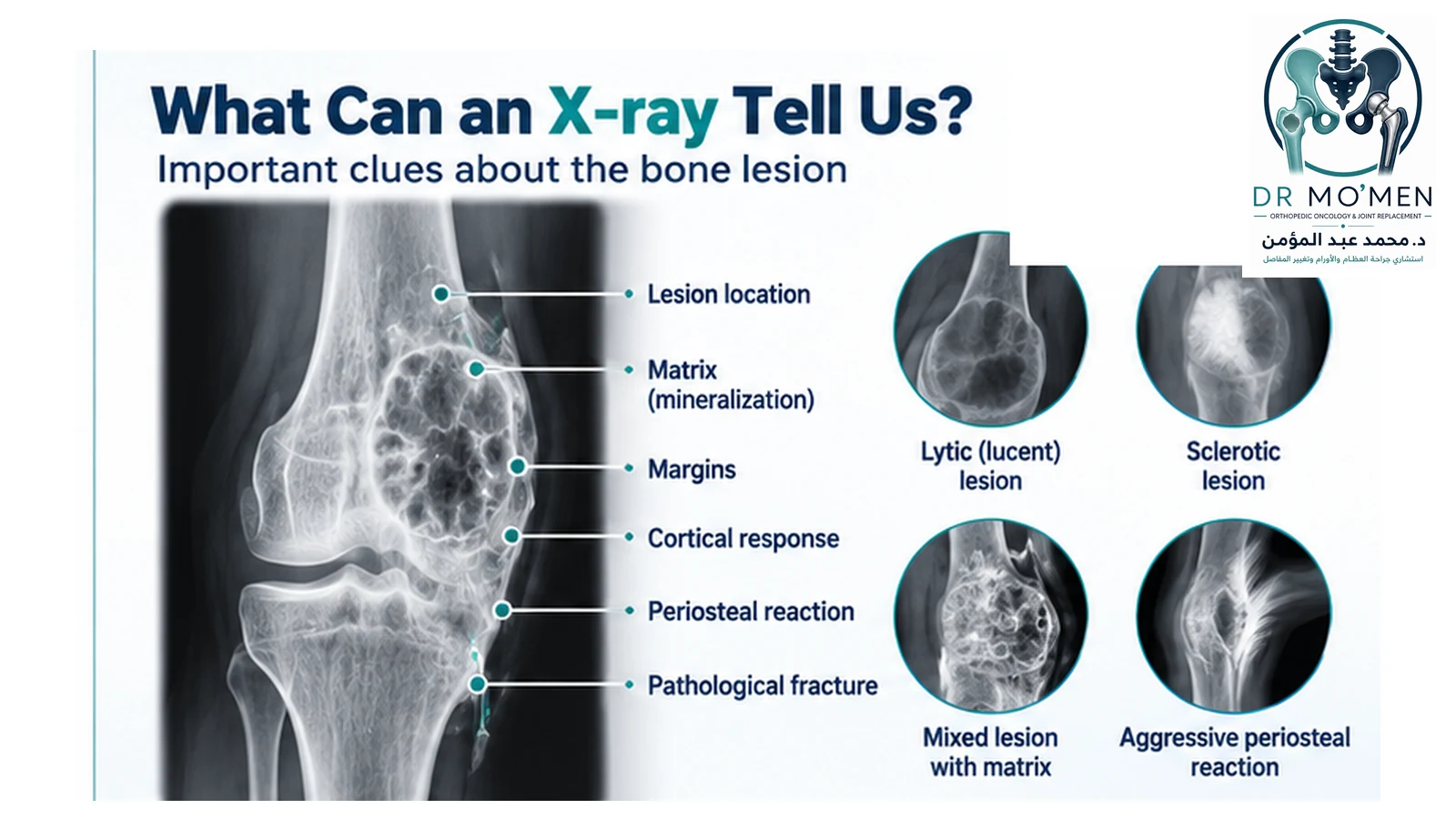 What Can an X-ray Tell Us? Medical infographic showing bone-tumor radiographic features including lesion location, matrix, margins, cortical response, periosteal reaction and pathological fracture.