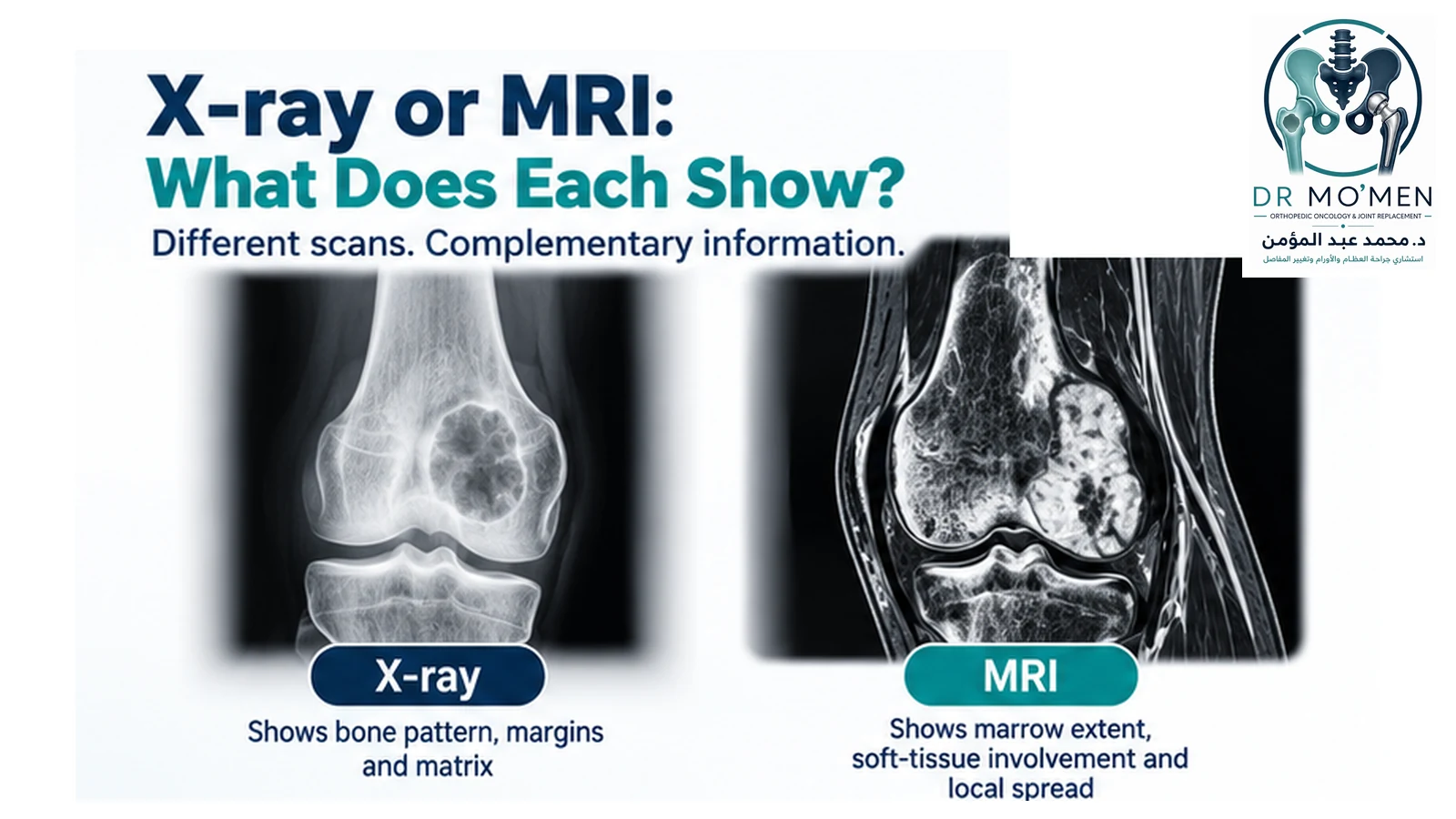 X-ray or MRI: What Does Each Show? Branded orthopedic oncology illustration comparing a bone lesion on plain X-ray and MRI and showing the different information provided by each modality.