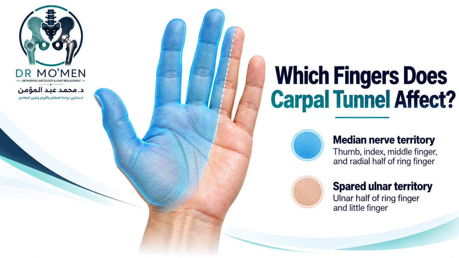 Typical Digital Sensory Distribution in Carpal Tunnel Syndrome Medical infographic showing carpal tunnel symptoms in the thumb, index, middle, and radial half of the ring finger, with the little finger and ulnar half of the ring finger spared.